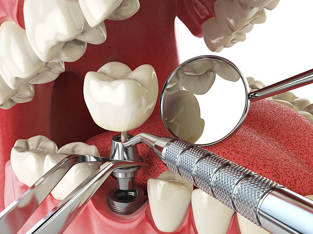 Best Emergency Dentist for Knocked-Out Tooth in West Rancho Dominguez, CA